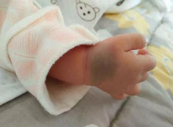 如何預(yù)防孕期產(chǎn)生胎記影響寶寶容貌