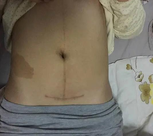 剖腹產的后遺癥要明白——傷口多久才能愈合