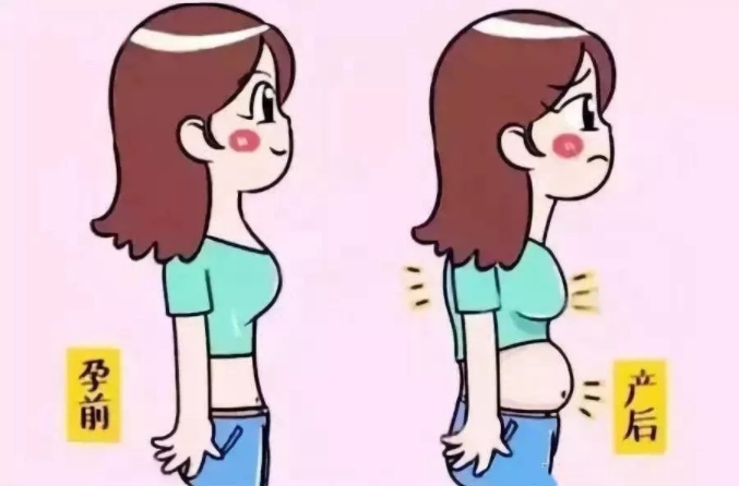 產(chǎn)后大肚腩，小心是腹直肌分離在作怪