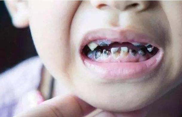 孩子滿口"黑牙"不一定是因為是糖果！