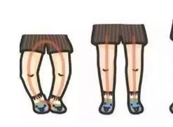 寶寶走路“八字腳”？或是因為家長做錯了這些事！