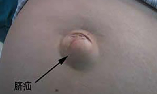 用硬幣壓肚臍可以治療臍疝么？千萬別盲目