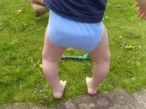 寶寶走路O型腿很擔(dān)心 一定要了解腿型發(fā)育