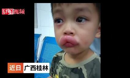 男孩吃葡萄過敏腫成嘟嘟嘴 現(xiàn)實版香腸嘴看著讓人心疼不已