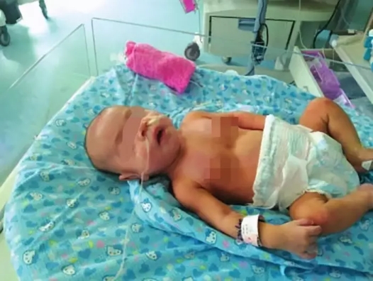 5月大女嬰雙腎長滿結(jié)石，過早添加輔食危害大