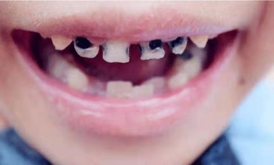 孩子長了“小黑牙”，不僅與糖果有關(guān)，還有這些壞習(xí)慣