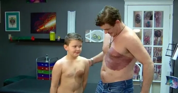 加拿大爸爸忍痛紋胎記，助力兒子擺脫自卑