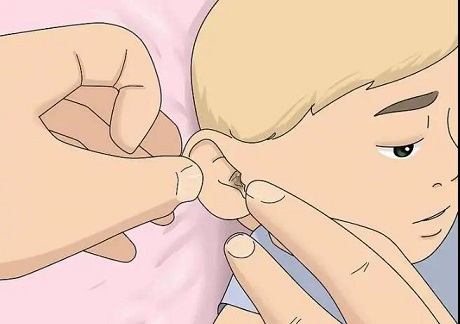 5歲女孩聽力下降，醫(yī)生檢查發(fā)現耳屎堵滿了耳道