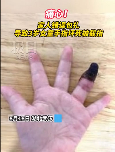 創(chuàng)可貼可別亂用，三歲女童因錯(cuò)誤包扎手指壞死