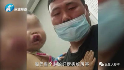 一歲寶寶嘴唇上翻，兩天后被確診白血病