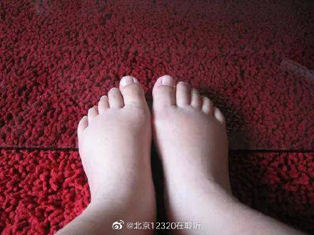 孕期生理性水腫需要治療嗎？