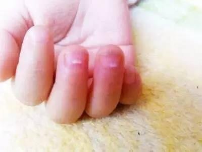 孩子上手的倒刺可能是身體在“求救”，家長(zhǎng)千萬要注意