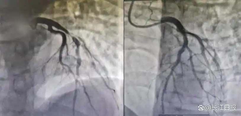 小伙熬夜+酗酒引發(fā)心梗，不良生活習慣正在摧毀年輕人的心臟